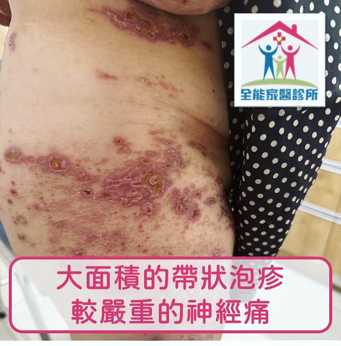 帶狀皰疹 帶狀皰疹